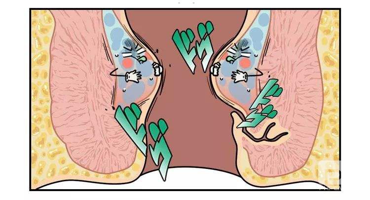 山西肛泰肛肠医院：孕妇的了痔疮怎样护理？