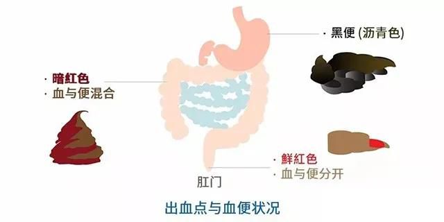 山西肛泰肛肠医院：便血是痔疮还是肠癌？