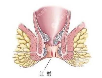 山西肛泰肛肠医院：真有人因为肛门疼痛致命！