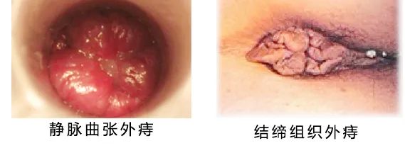 山西肛泰肛肠医院：关于痔疮，你想知道的全在这了