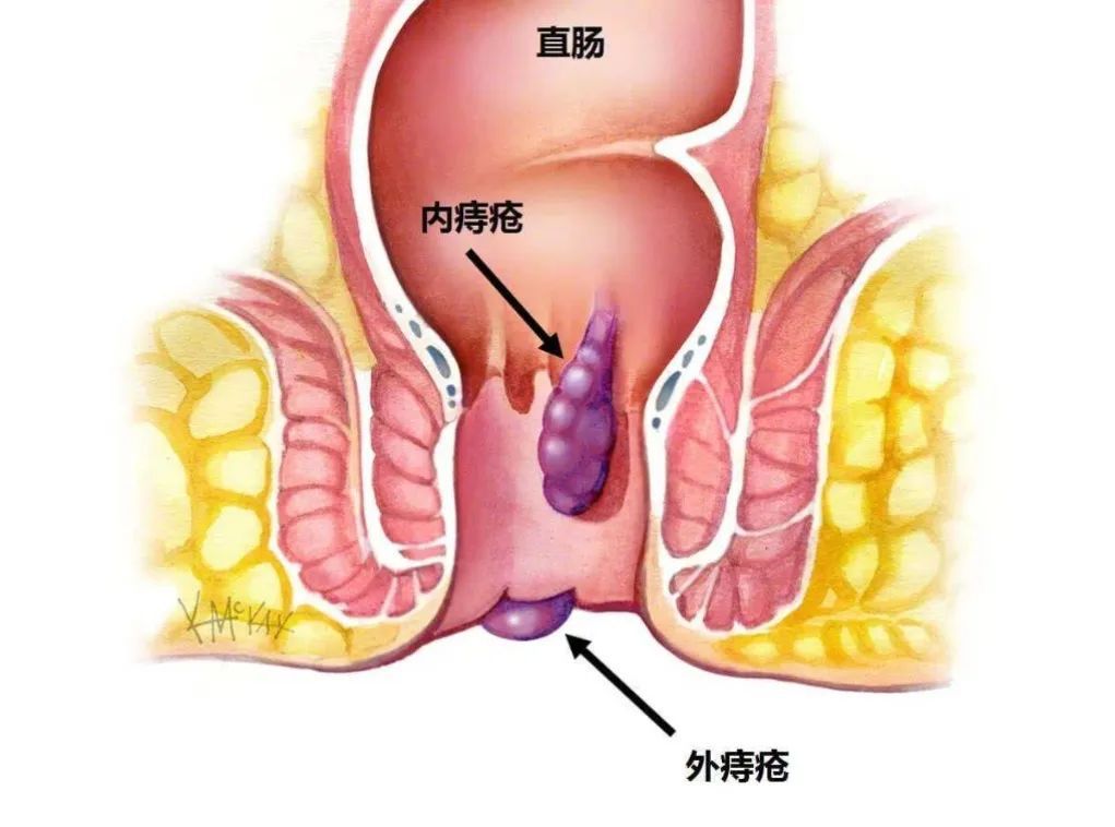 山西肛泰肛肠医院：五大特征，帮你区分痔疮与肛瘘！