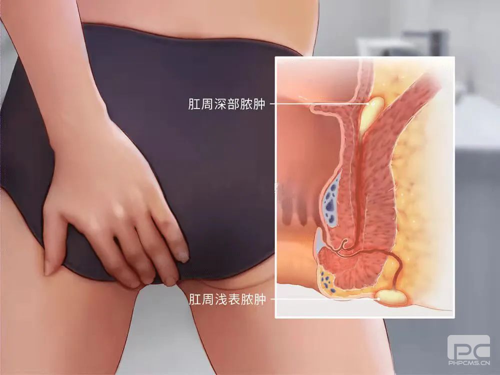 山西肛泰肛肠医院：痔疮的护理注意事项