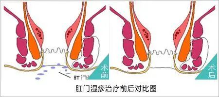 山西肛泰肛肠医院：肛门湿疹有哪些危害