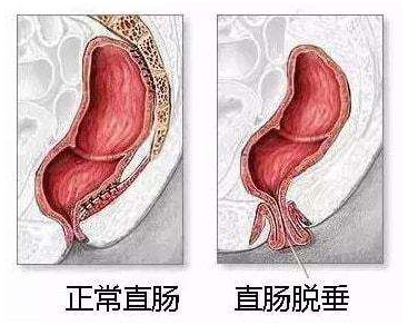 山西肛泰肛肠医院：脱肛不治是否可以自愈？