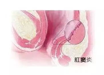 山西肛泰肛肠医院：肛周疼痛的原因？