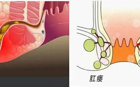山西肛泰肛肠医院：得了肛瘘只能做手术吗？