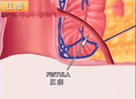 山西肛泰肛肠医院：肛门长包流脓是肛瘘吗？