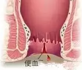 山西肛泰肛肠医院：便血等于痔疮？痔疮表示：这锅我不背！