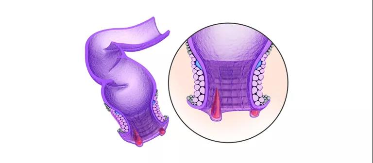 山西肛泰肛肠医院：都是痔疮，凭什么我的这么野？