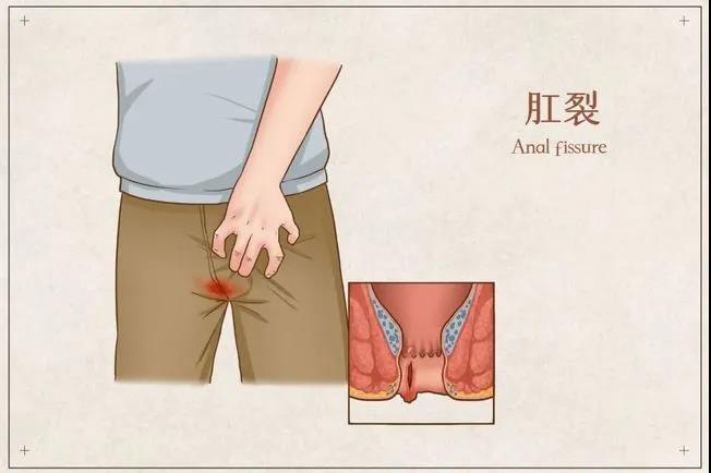 山西肛泰肛肠医院：肛裂一定要做手术吗？可以自己调理吗？