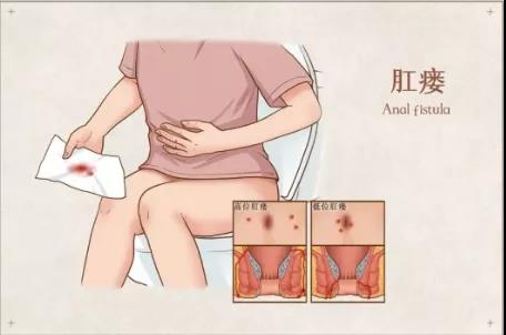 山西肛泰肛肠医院：肛周脓肿“重男轻女”，男性朋友一定要小心预防