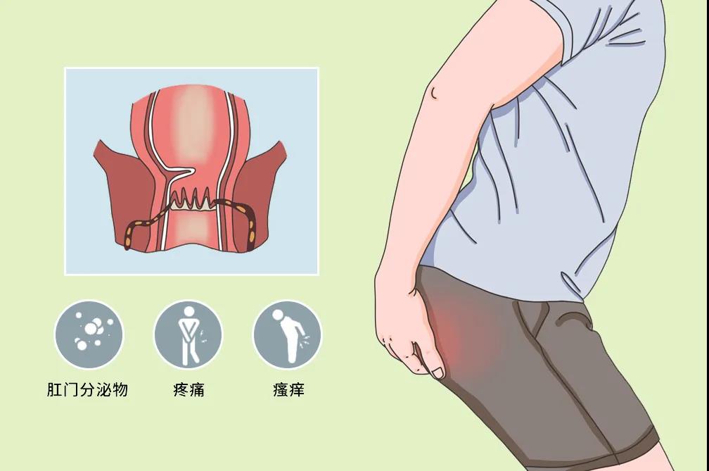 山西肛泰肛肠医院：肛瘘形成历经四个阶段，“堵瘘”要专业及时