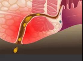 山西肛泰肛肠医院警报 肛瘘没那么简单
