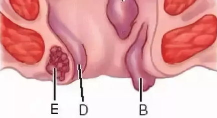 山西肛泰肛肠医院：混合痔，是两种痔疮混合在一起吗？