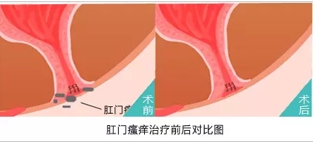山西肛泰肛肠医院：肛门痒便血是怎么回事
