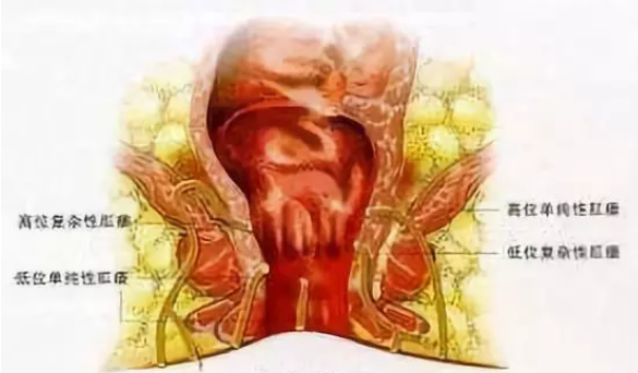 山西肛泰肛肠医院：哪种肛裂才需要做手术你知道吗？