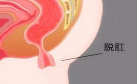 山西肛泰肛肠医院：脱肛怎么治疗？肛门有东西脱出是什么情况？