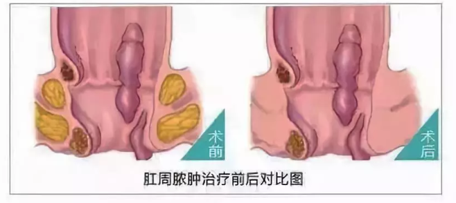 山西肛泰肛肠医院：肛周脓肿的危害比你想象的更可怕