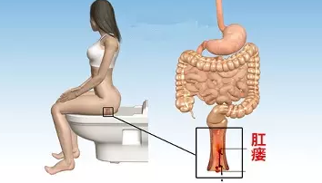 山西肛泰肛肠医院：肛瘘危害到底有多大！