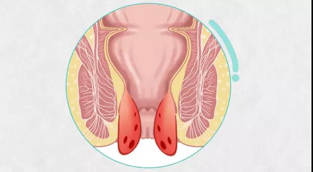太原肛肠医院：肛门疼痛是痔疮还是肛裂？
