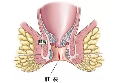 山西肛泰肛肠医院：肛裂可以自己愈合吗？
