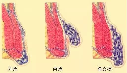 山西肛泰肛肠医院：得了痔疮就一定会疼？你要看看这个？