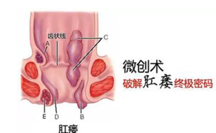 山西肛泰肛肠医院：肛瘘到底是怎么回事呢？一起来看看吧~