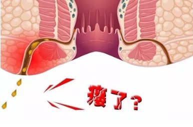 太原肛肠医院：痔疮到肛瘘只有一步之遥！