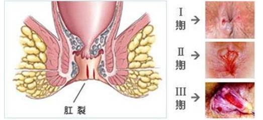山西肛泰肛肠医院：引起肛裂的原因，如何有效预防肛裂