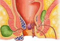 山西肛泰肛肠医院：肛周脓肿者须警惕糖尿病