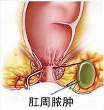 山西肛泰肛肠医院：预防肛周脓肿需了解其病发原因