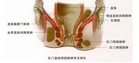 山西肛泰肛肠医院：肛周脓肿的危害不可轻视