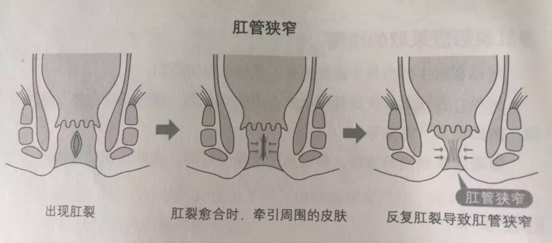 山西肛泰肛肠医院：关于肛裂的知识点，看这一篇就够了！