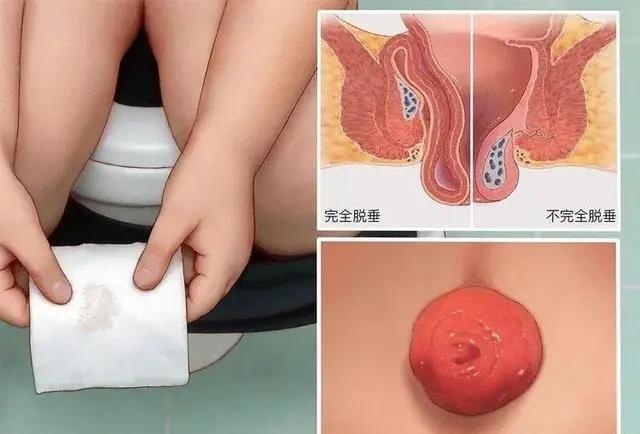 山西肛泰肛肠医院：痔疮上药总不好？要当心可能是直肠脱垂！