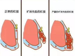 山西肛泰肛肠医院：女性痔疮可导致肥胖  日常需注意个人卫生