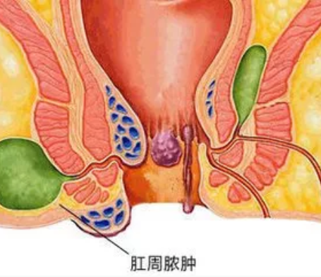 山西肛泰肛肠医院：肛周脓肿待敌是怎么回事？