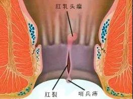 山西肛泰肛肠医院：痔疮最专业的问答，你想知道的都在这里！