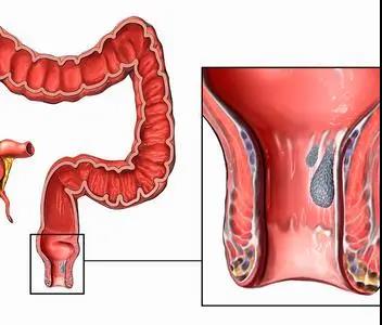 山西肛泰肛肠医院：痔疮一定要手术治疗吗？什么情况需要手术治疗？