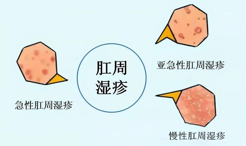 山西肛泰肛肠医院：肛门经常发痒，跟痔疮有关系吗？