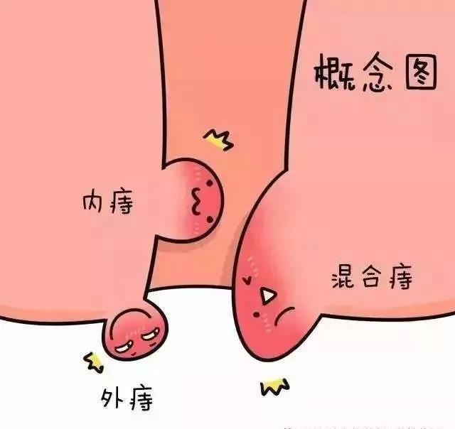山西肛泰肛肠医院：患了痔疮，为什么有的人不疼？有的人疼？