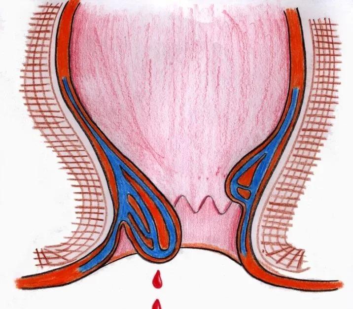 山西肛泰肛肠医院：大便有血看什么科？便中带血？该如何区分病状？