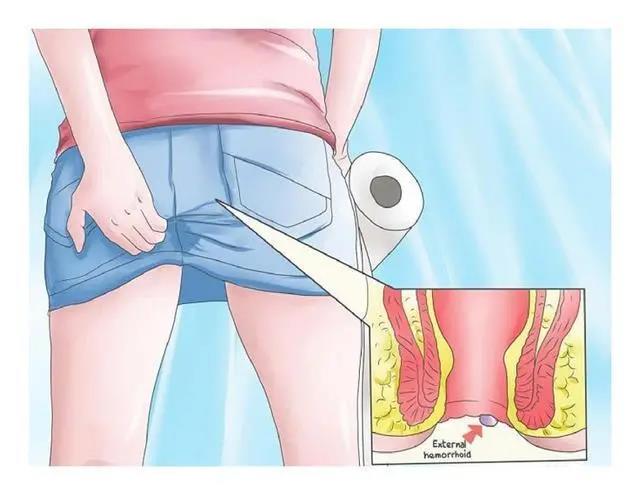 山西肛泰肛肠医院：导致内痔发生的三种主要原因