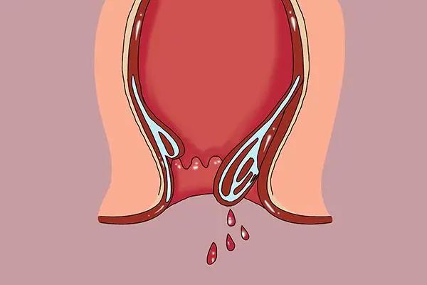 山西肛泰肛肠医院：便血的问题，可大！可小！