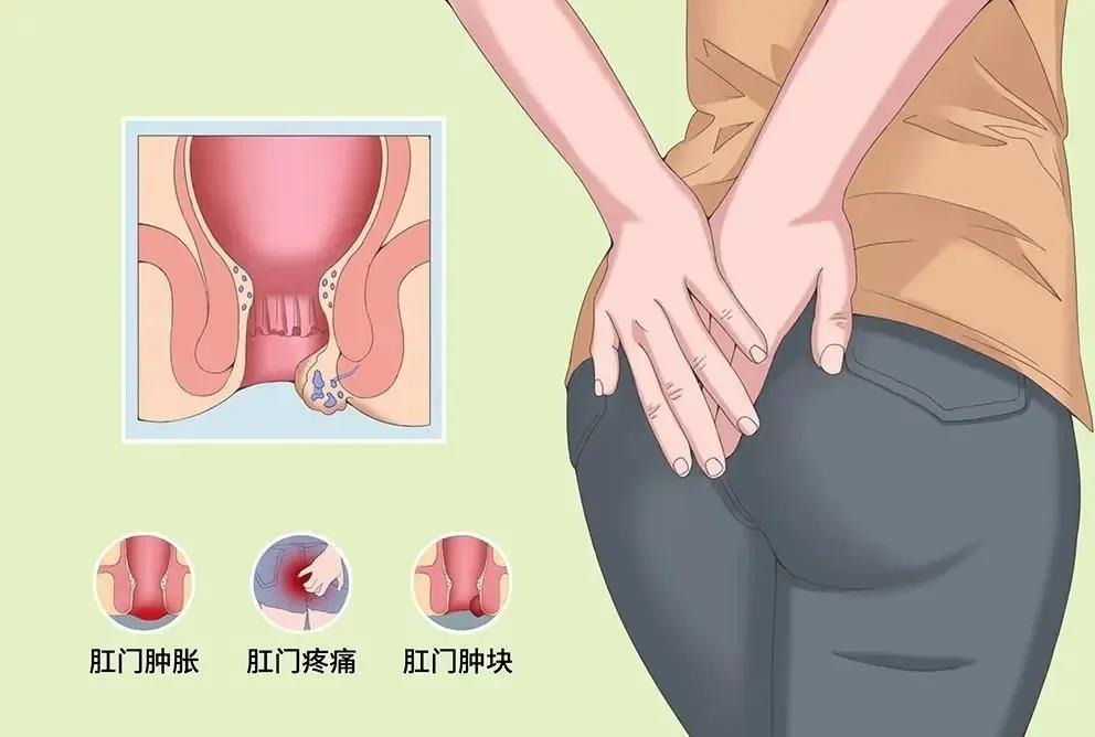山西肛泰肛肠医院：痔疮的高发人群有哪些？那些人更容易得痔疮？