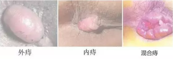 山西肛泰肛肠医院：三分钟辨别内痔、外痔、混合痔......