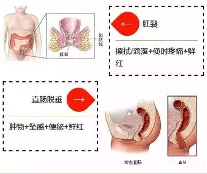 山西肛泰肛肠医院：便血三原色一“黑、暗、红”