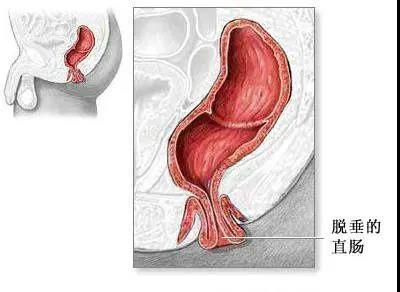 山西肛泰肛肠医院：说到直肠脱垂就菊花一紧，究竟会不会自愈呢？