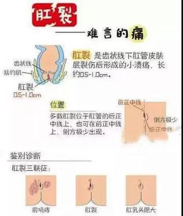 山西肛泰肛肠医院：“菊花痛，满腚伤”！被我们忽视的肛门疼痛原因还真不少