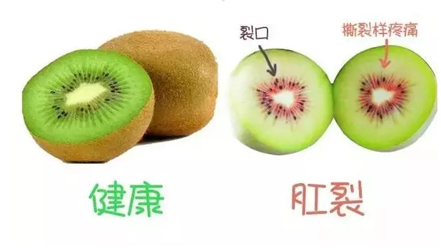 山西肛泰肛肠医院：“菊花”痛起来要命？很可能是这几种肛肠疾病引起的！