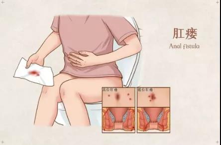山西肛泰肛肠医院：肛瘘痔疮区别大，别错把“肛瘘”当‘痔疮’